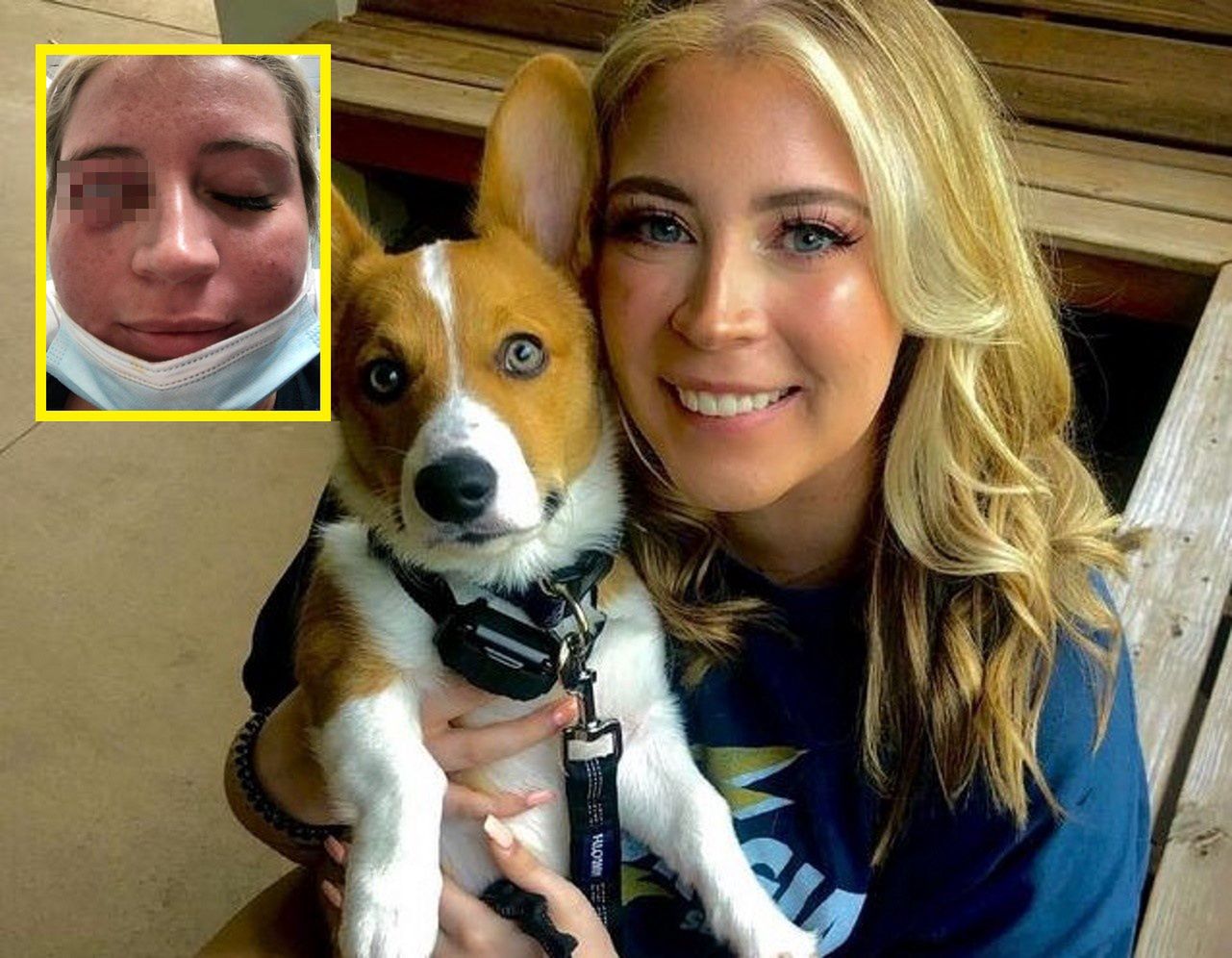 Tragedia podczas zabiegu upiększającego. 23-latka straciła powiekę
