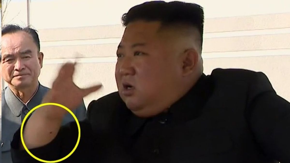Zdjęcia wykonane 1 maja, ukazują ślady na nadgarstku Kim Dzong Una.