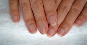 Masz taką kreskę na paznokciu? To objaw groźnej choroby