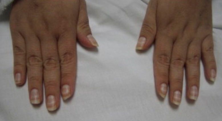 Paznokcie Muehrckego u pacjentki z zespołem nerczycowym 