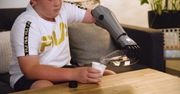 Technologiczna sensacja. 11-latek dostał bioniczne ramię
