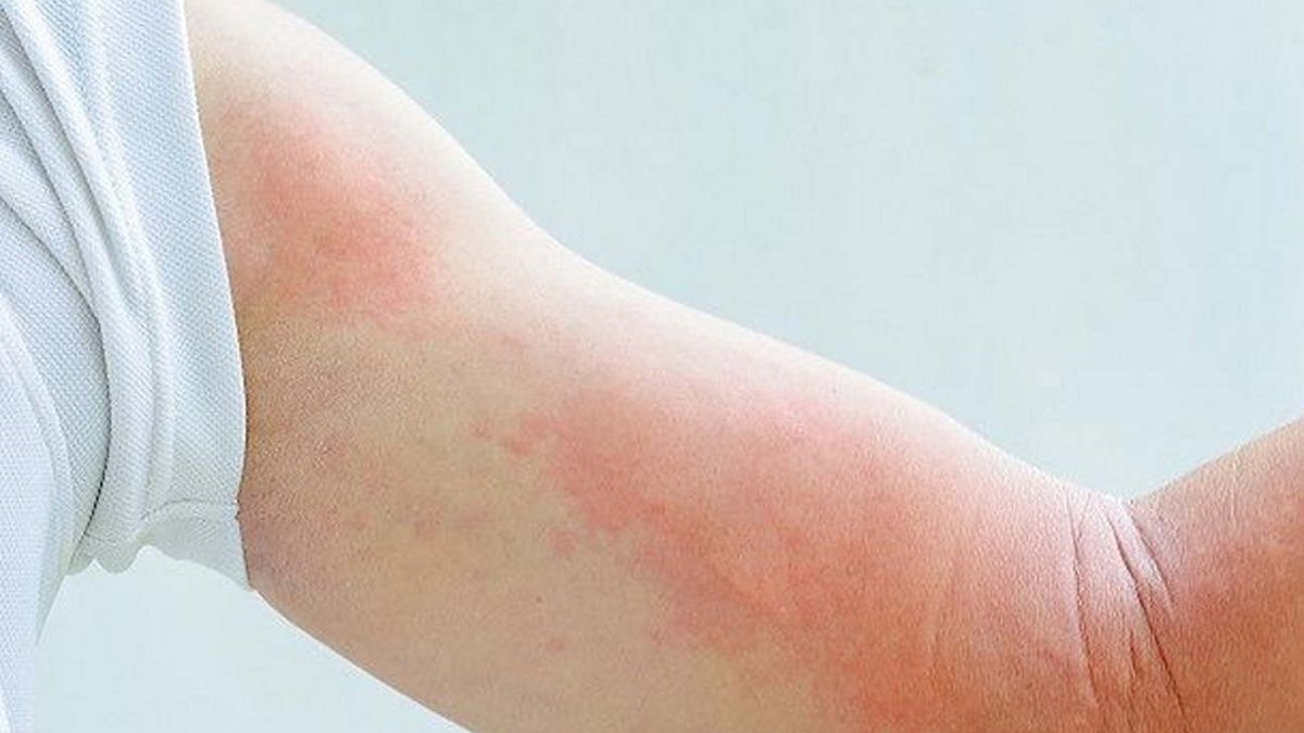 Objawem kiły jest m.in. wysypka