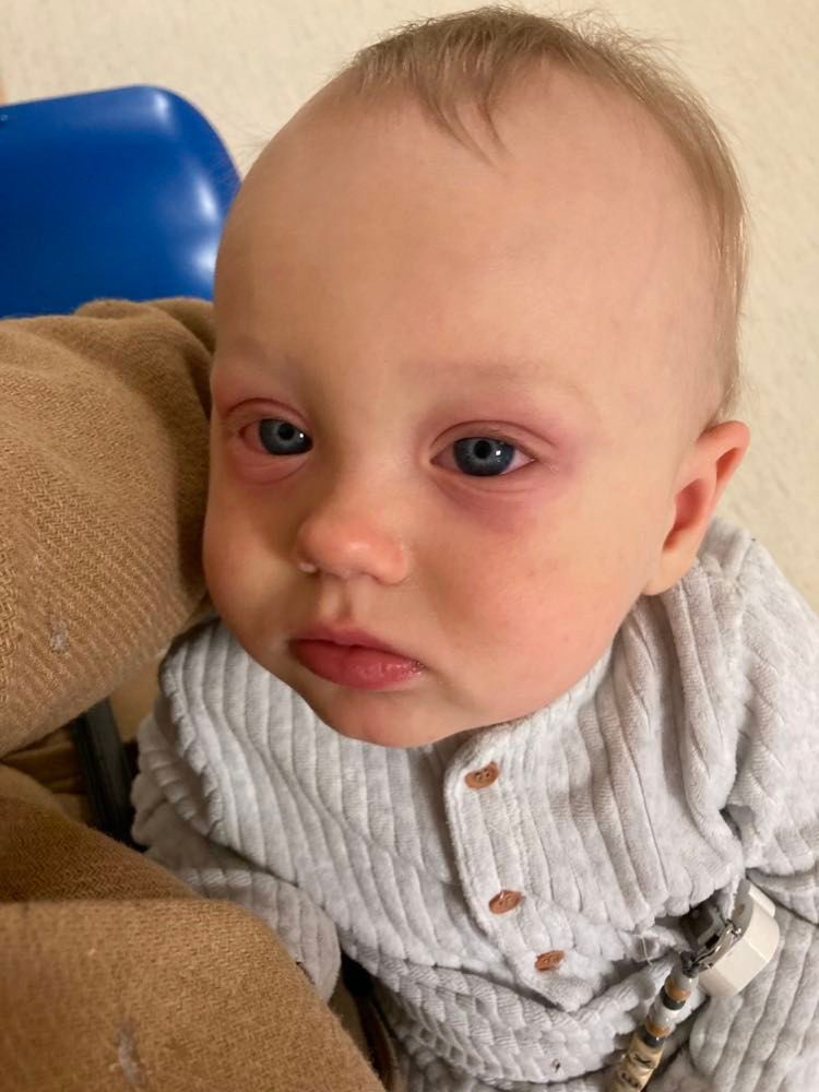 Typowym objawem PIMS są zaczerwienione spojówki