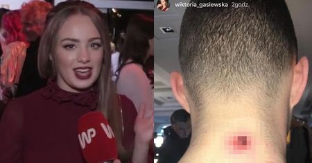 Gąsiewska broni wielkiej krosty Zdrójkowskiego: "Od razu afera, że co ja udostępniłam!"