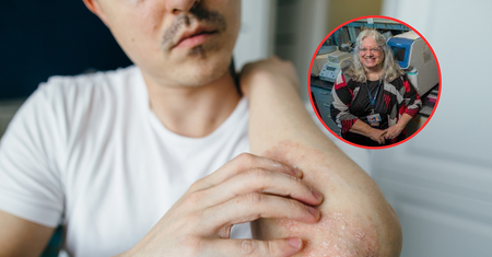 Zaczyna się od zmian na skórze. Sprzyja cukrzycy, demencji, zawałom