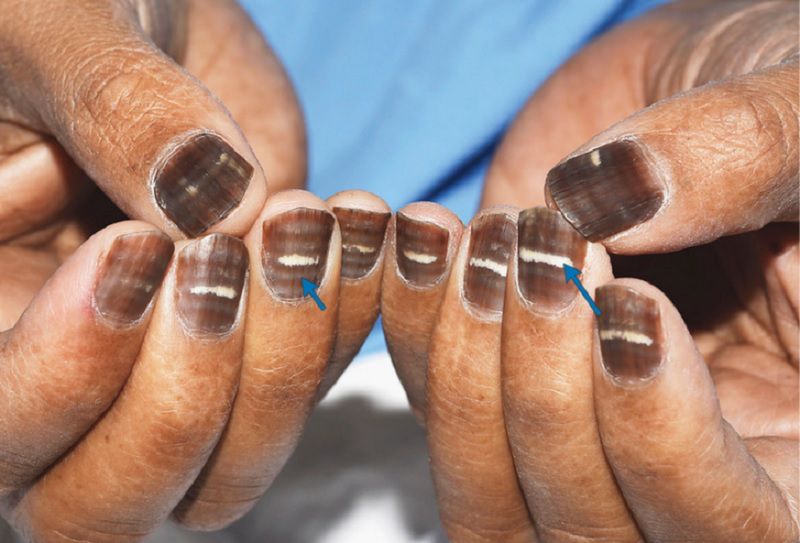 W czasie chemioterapii paznokcie pacjenta stały się brązowe