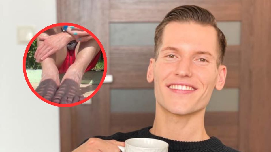 Paznokciowa afera wokół Jacka Jeschke. Podolog rozwiewa wątpliwości