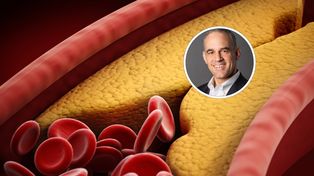 Czyści tętnice. "Cofa blaszkę miażdżycową, zapobiega zawałom"