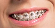 Na aparat ortodontyczny nigdy nie jest za późno