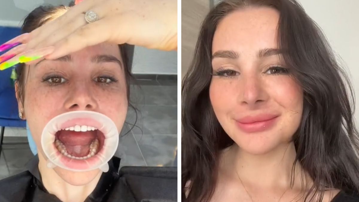 Zrobiła sobie "tureckie zęby". Tak teraz wygląda jej uśmiech. 