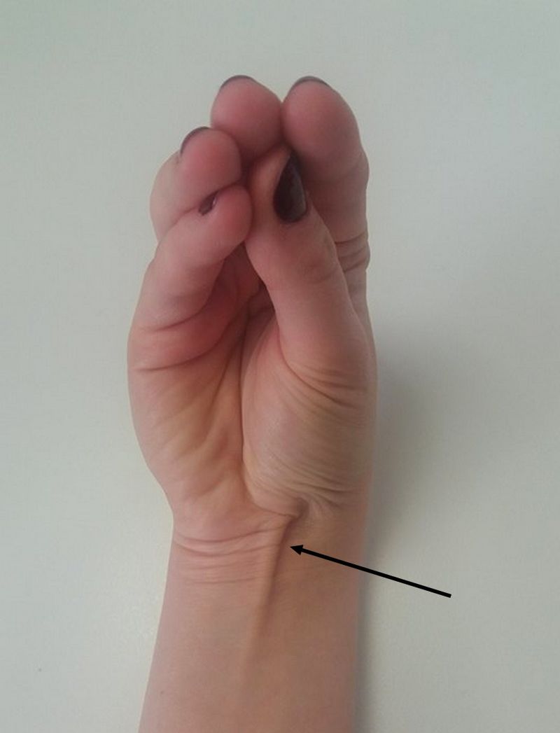 15 proc. osób na świecie nie ma tego mięśnia