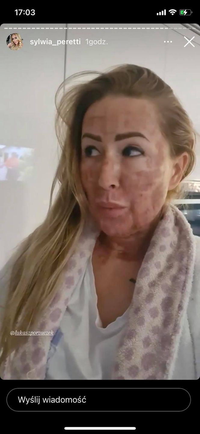Sylwia Peretti po zabiegu laserowym
