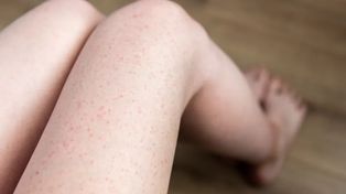 Czym prędzej wyrzuć z łazienki. Może powodować "truskawkowe nogi"