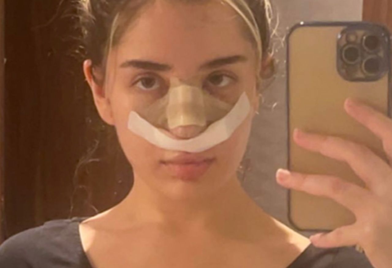 TikToker's nightmare rhinoplasty journey in Turkey exposes the realities of cosmetic surgery