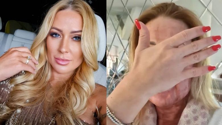 Sylwia Peretti po zabiegu laserowym