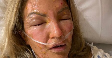 Uważaj na ogień po dezynfekcji rąk! To może zakończyć się tragedią