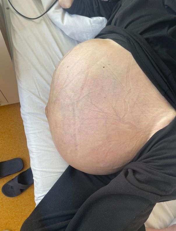 38-letnia pacjentka miała 20-kg guza