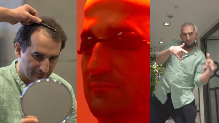 Misiek Koterski zamieścił vlog z zabiegu PRZESZCZEPU WŁOSÓW w Turcji: "Marcelka mówi, że wyglądam jak BABA JAGA"