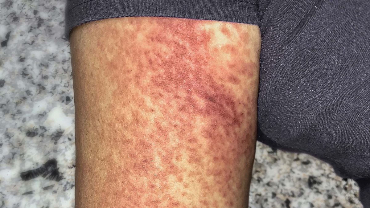 Do objawów sepsy należy charakterystyczna, wybroczynowa wysypka