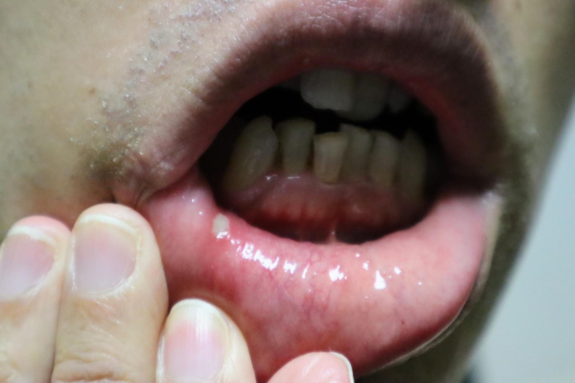 Afty i owrzodzenia jamy ustnej mogą wskazywać na niedobór witaminy B12