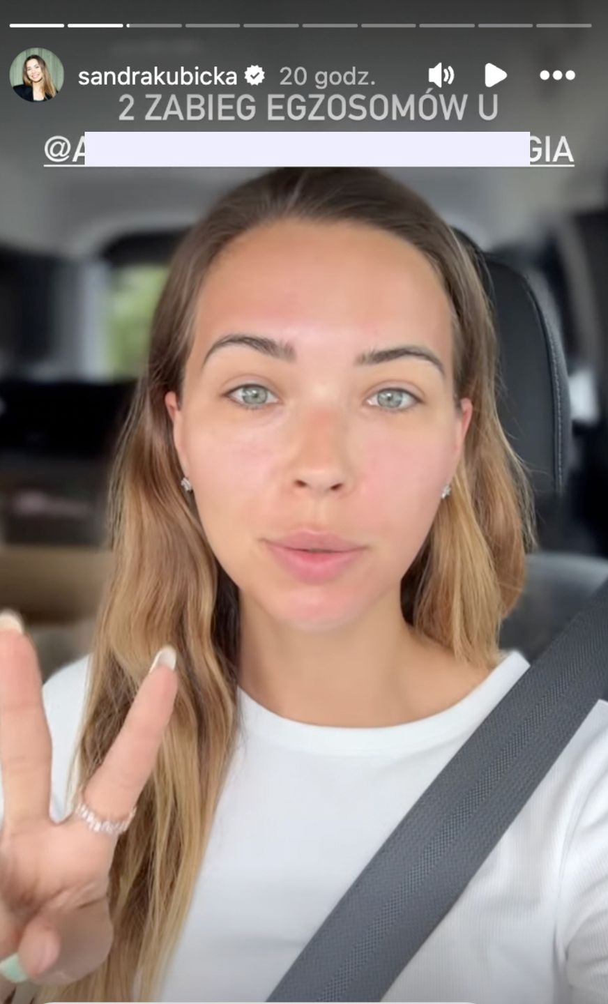 Sandra Kubicka opowiedziała o ostatnim zabiegu twarzy