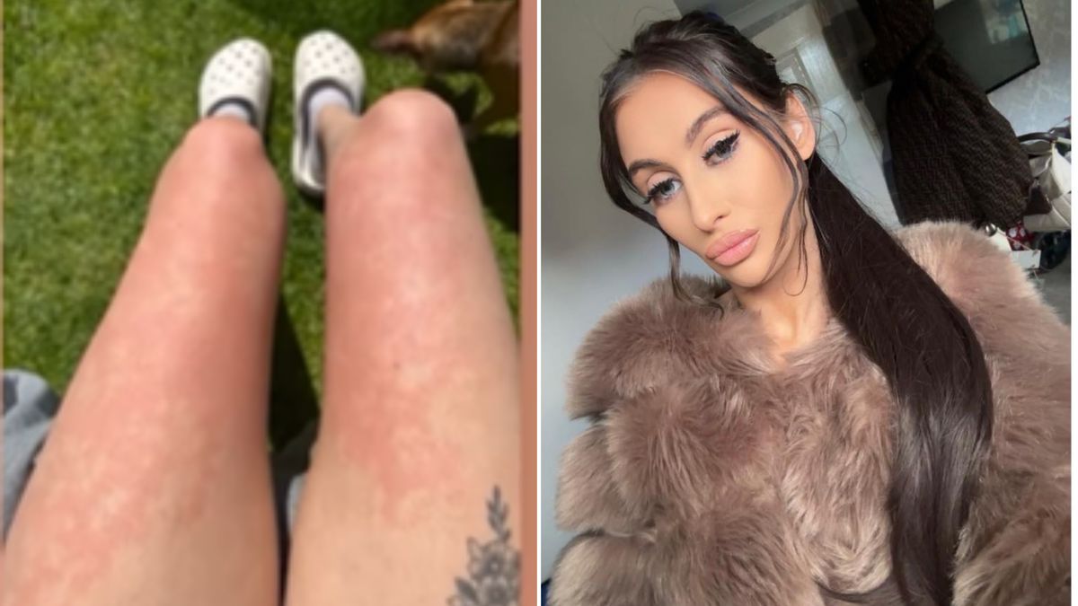 Brytyjka cierpi na alergię na wodę.