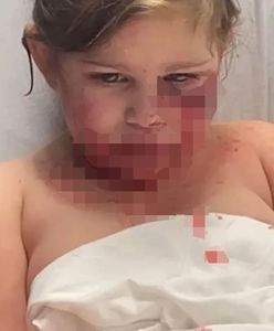 "Nie będzie mogła się uśmiechać". 3-latka pogryziona przez psa