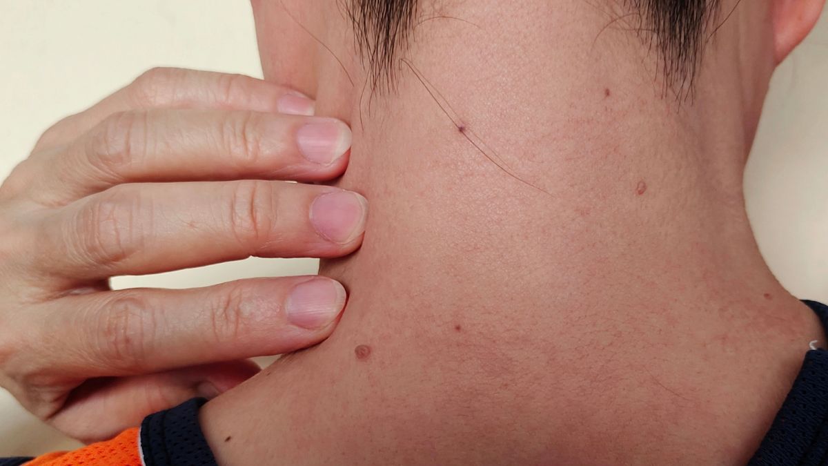 Kurzajka czy czerniak? Znamiona trzeba obserwować