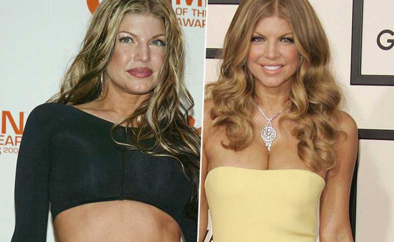 Fergie - przed i po operacji biustu