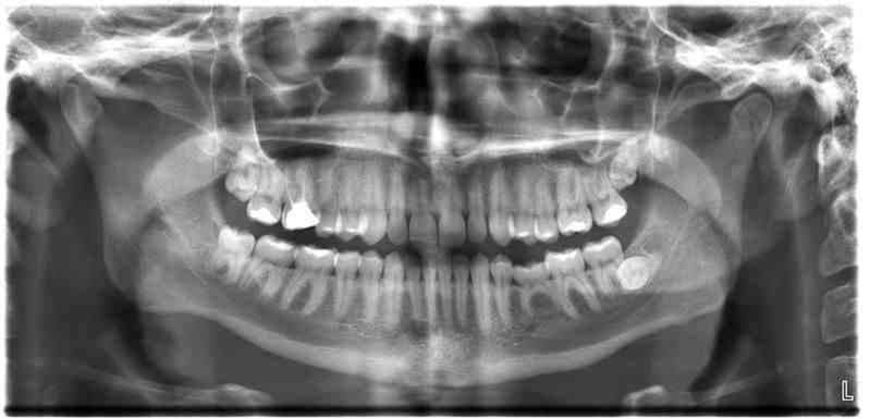 Zdjęcie RTG zębów