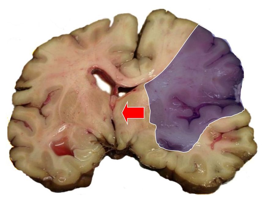 Ilustracja udaru mózgu 
