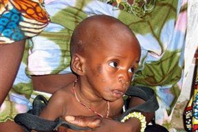 1/3 dzieci na świecie umiera z niedożywienia