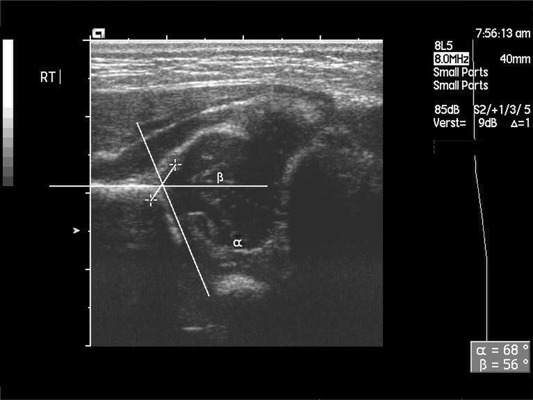 Dysplazja stawu biodrowego widoczna na USG u noworodka 