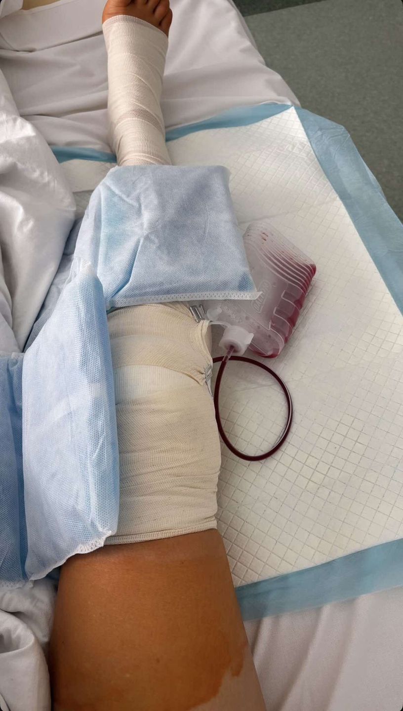Joanna Opozda pokazała spuchniętą nogę po zdjęciu opatrunku