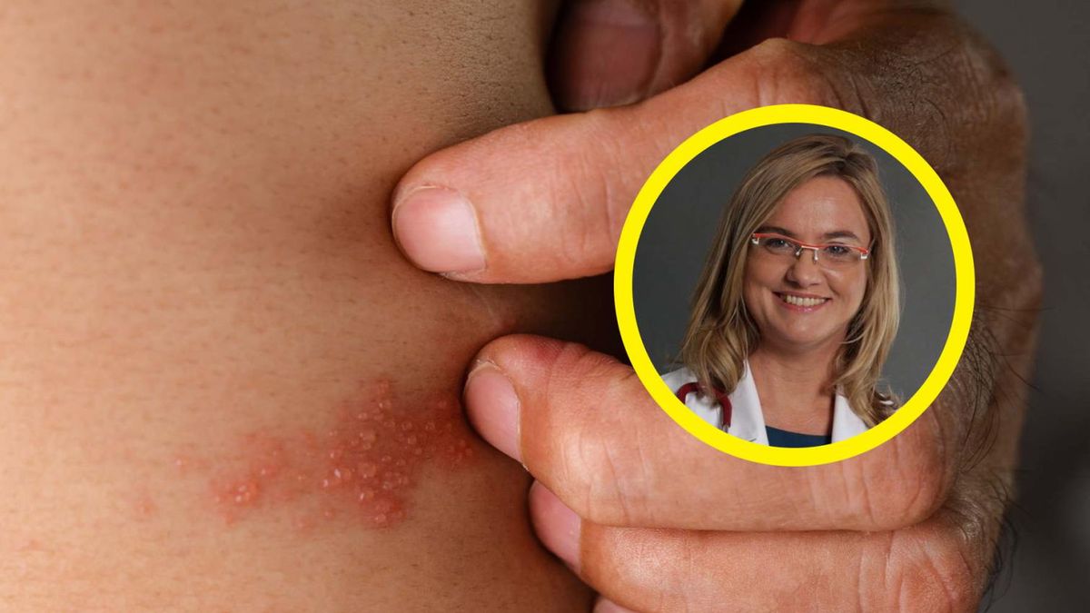 Dorośli gorzej przechodzą ospę. "Najczęstszym powikłaniem jest zapalenie płuc"