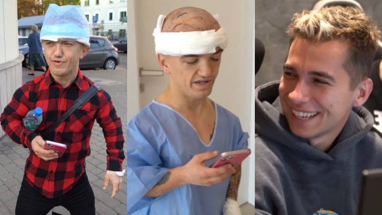 Mini Majk relacjonuje przeszczep włosów