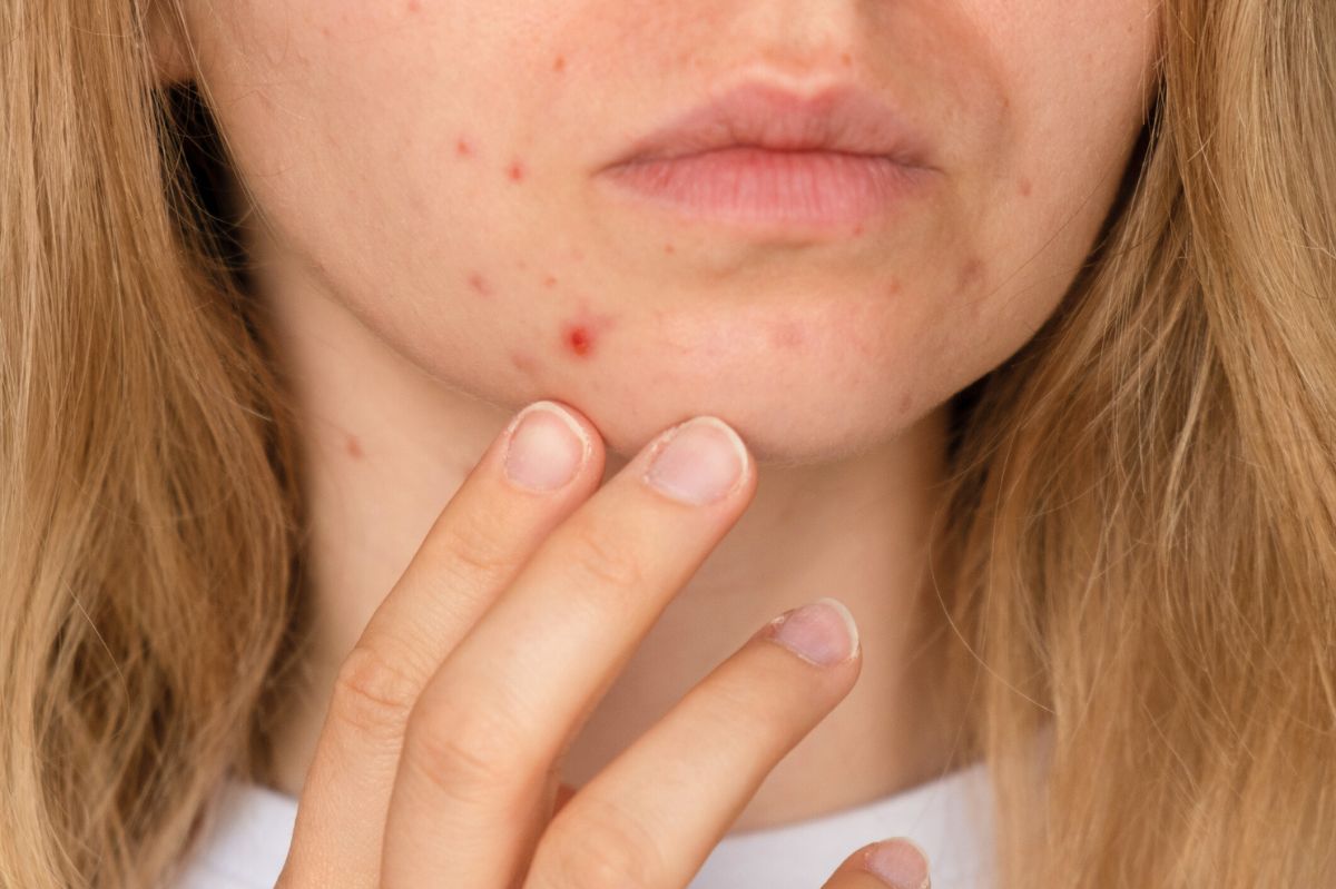 Woman with acne on her face
