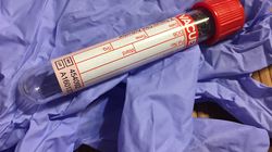 Lym morfologia - normy, podwyższone i obniżone wartości limfocytów