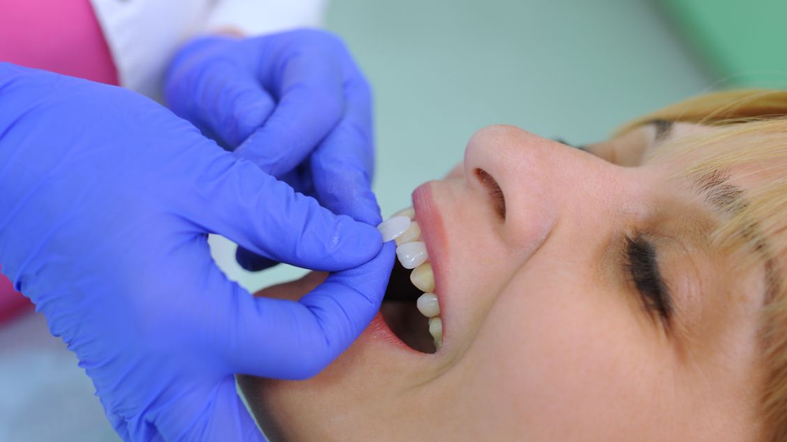 Licówki są doskonałym rozwiązaniem dla osób, które pragną skorygować naturalną barwę zębów,