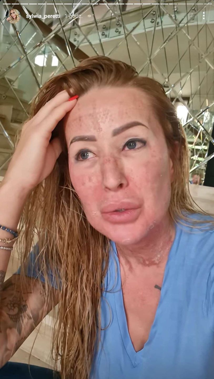 Sylwia Peretti pokazuje kolejny etap po zabiegu laserowym. Jest lepiej? 