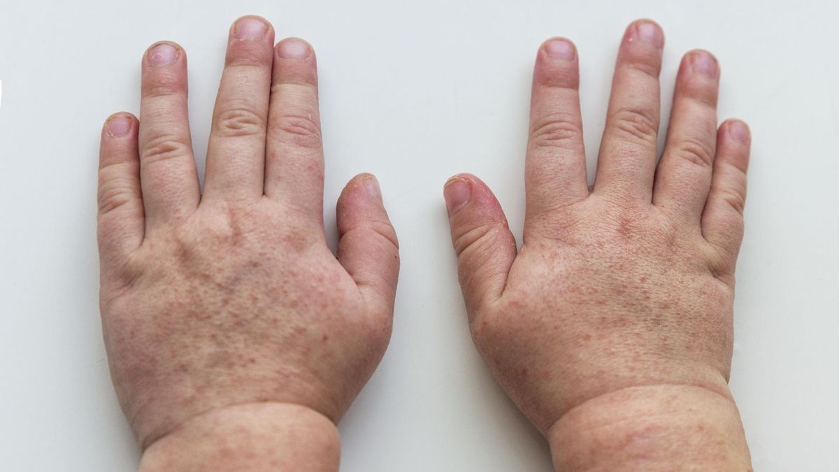 Większość zachorowań na szkarlatynę przypada na okres jesienno-zimowy.