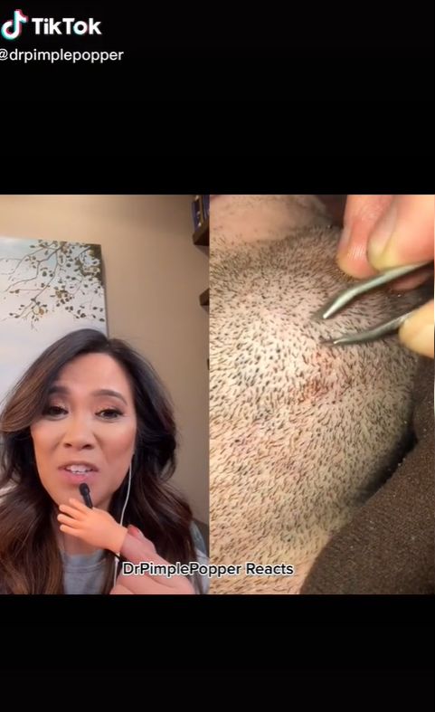 Lekarka ostrzega, by nie wyrywać włosków, które wrastają