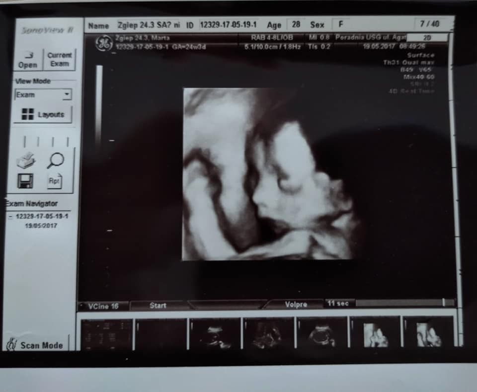 Podczas badań w ciąży okazało się, że chłopiec ma poważną wadę serca