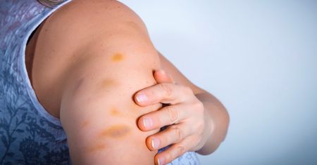 Gdy pojawia się na skórze, uważaj. Może ostrzegać o raku, chorej wątrobie