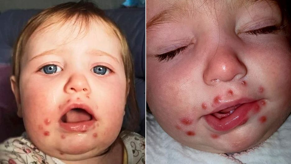 Opryszczka u niemowląt może być śmiertelnie niebezpieczna 