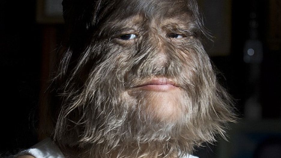 Najbardziej owłosiona dziewczynka na świecie