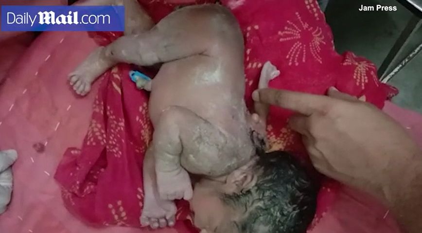 W Indiach urodziło się dziecko z trzecią ręką 
