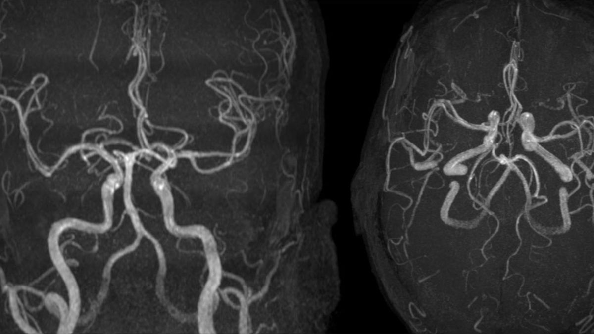 Cechy kliniczne i neuroradiograficzne leukoencefalopatii wywołanej wdychaniem fentanylu