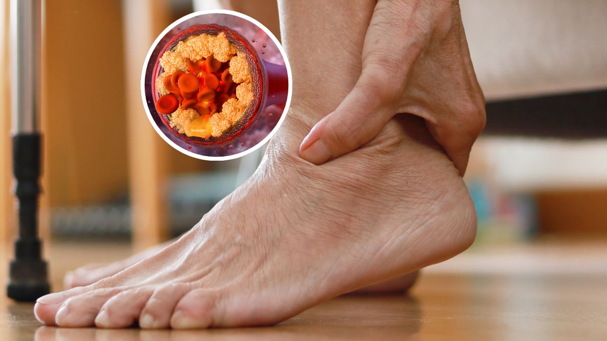 Nietypowy objaw podwyższonego cholesterolu