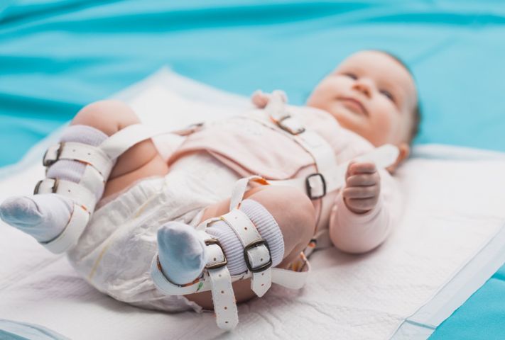 U noworodków najczęściej rozpoznaje się dysplazję stawu biodrowego.